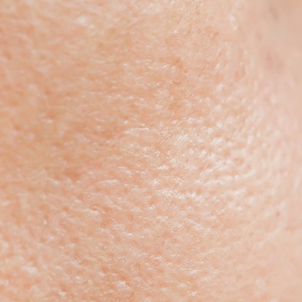 Pele com efeitos da acne