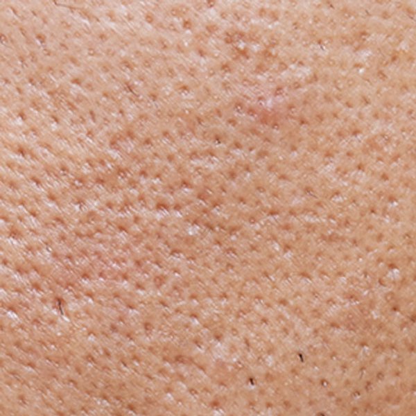 Artigo sobre acne - imagem principal