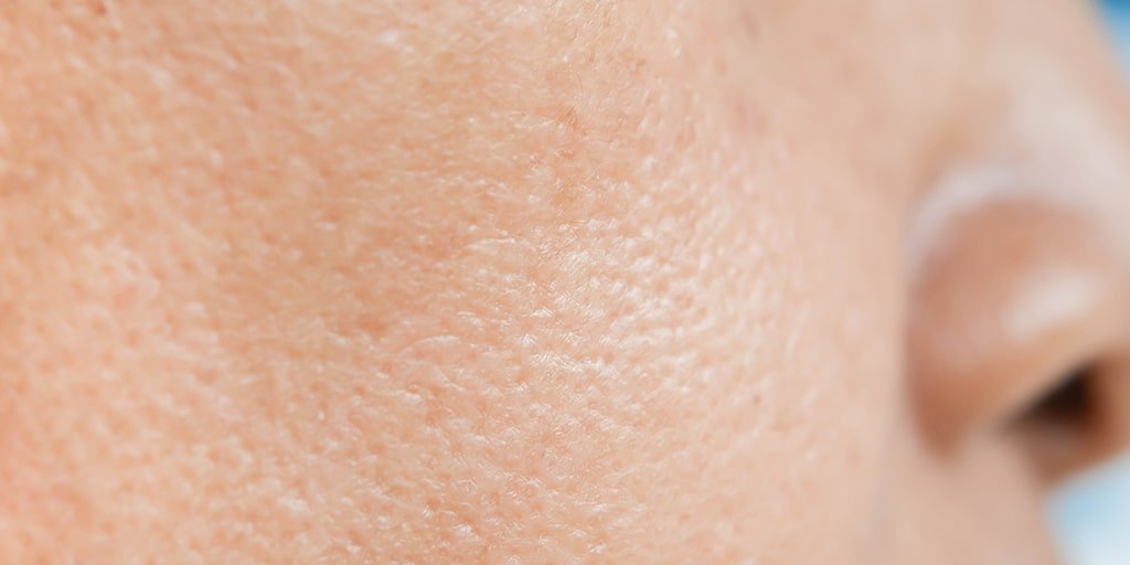 Pele com efeitos da acne
