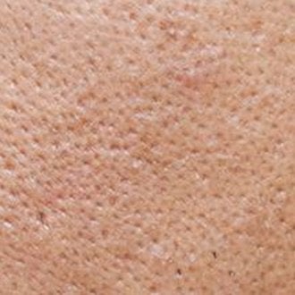 Tudo sobre acne e pele oleosa