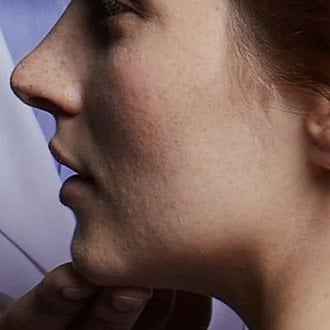TRATAMENTOS MÉDICOS PARA ACNE: DICAS DE DERMATOLOGISTA