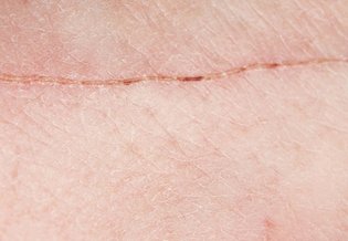 Larocheposay-ArticlePage-Damaged-How-to-optimise-scar-healing