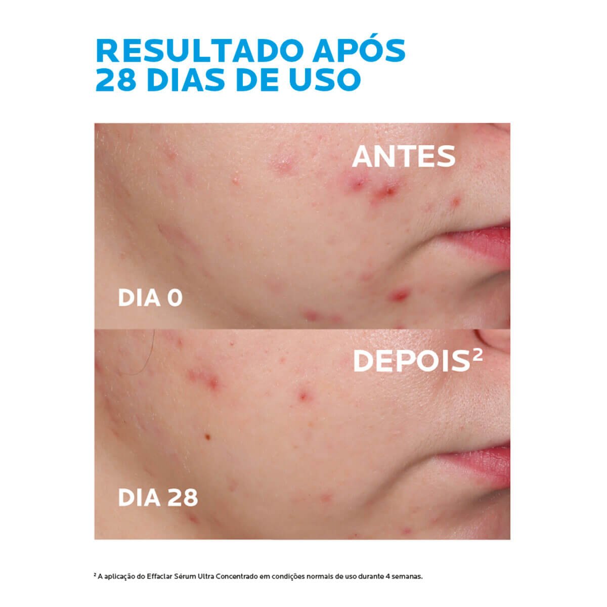 Imagem Sérum Antiacne Ultra Concentrado | Effaclar | Antes e Depois | La Roche-Posay